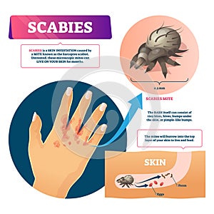 Scables vector illustration. Labeled educational skin infestation scheme. photo