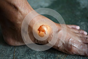 The scald on the foot skin caused