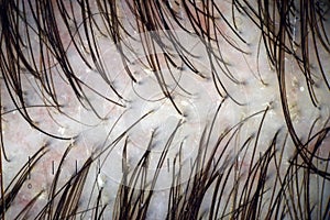 Scalp and hair with multiple exfoliation.