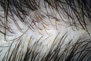 Scalp and hair with multiple exfoliation. Macroscopy of hair on the head with signs of peeling at hair follicles.
