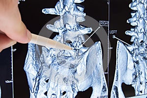 Scan of lumbosacral spine. Doctor pointed on area of lumbar, where pathology is detected, such as radiculitis, radiculopathy, hern