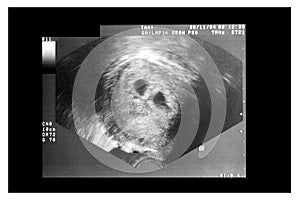 Scan for pregnancy