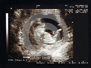 Scan on pregnancy, foetus