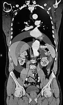 Scan tomography thoracic aorta aneurism