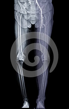 Scanogram image fusion with CTA lower extremities