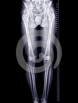Scanogram of lower limb or X-ray image of total lower extremity with scale.
