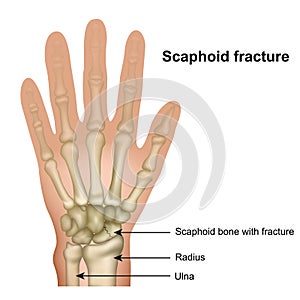 Scaphoid bone fracture medical  illustration on white background