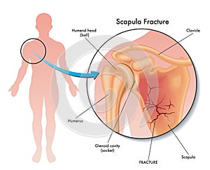 Scapula fracture illustration