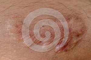 A scar is an area of fibrous tissue that replaces normal skin after an injury.