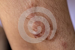 A scar is an area of fibrous tissue that replaces normal skin after an injury.