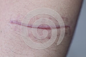 A scar of fibrous tissue that replaces normal skin after an injury on skin.