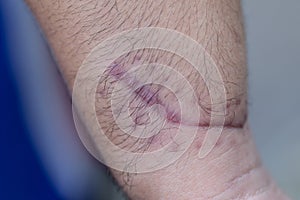 A scar of fibrous tissue that replaces normal skin after an injury on skin.