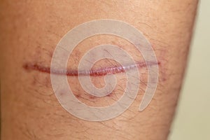 A scar of fibrous tissue that replaces normal skin after an injury on skin.