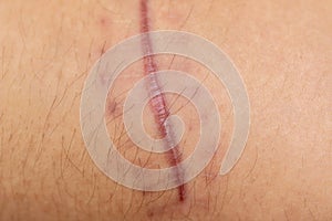 A scar of fibrous tissue that replaces normal skin after an injury on skin.