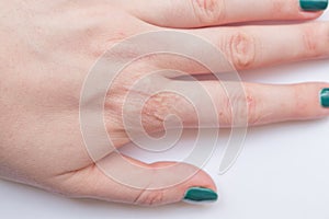 Scar on the finger of a man on a white background. Scar from a cut and burn on a female hand with a beautiful manicure