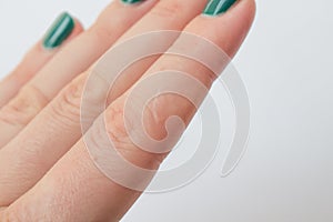 Scar on the finger of a man on a white background. Scar from a cut and burn on a female hand with a beautiful manicure