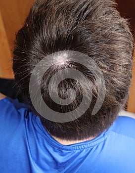 Scar on head from Aplasia Cutis Congenita photo