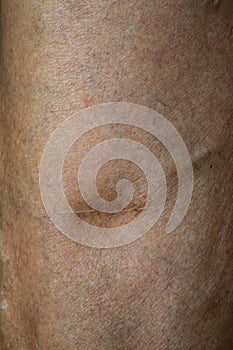 Scar from operate on Varicose veins on a leg in Senior women, Close up & Macro shot, Selective focus, Body skin part, Healthcare