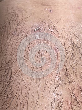 Scar on skin. The wound form scabs on leg. Man with long scab wound on right leg.