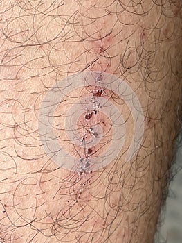 Scar on skin. The wound form scabs on leg. Man with long scab wound on right leg.