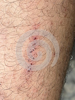 Scar on skin. The wound form scabs on leg. Man with long scab wound on right leg.