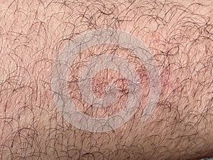 Scar on skin. The wound form scabs on leg. Man with long scab wound on right leg.