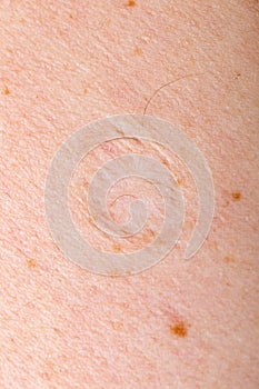 Scar tissue on human skin