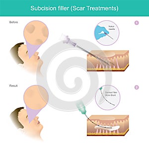 Scar treatments. Illustration explain a treatment that involves cutting the strands