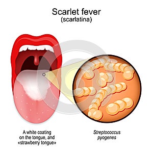 Scarlet fever. mouth with symptoms of scarlatina
