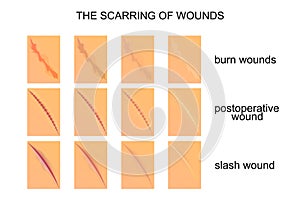 The scarring of wounds