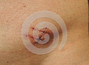 Scars on the abdomen of patient