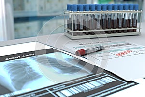 Scene in the lab with a lung x-ray and a test tube with a blood test.