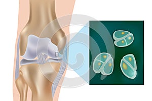 Schematic depiction of articular cartilage and chondrocytes of the joint surface. Structural and molecular changes photo