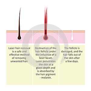 Scheme of laser hair removal. Description of the cosmetology procedure.