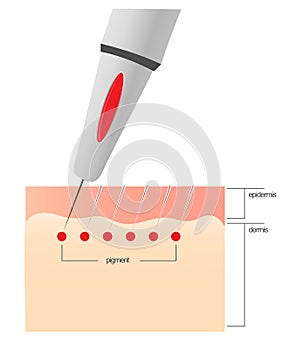 The scheme of the procedure of permanent makeup.