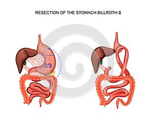 Scheme of resection of the stomach Billroth 2
