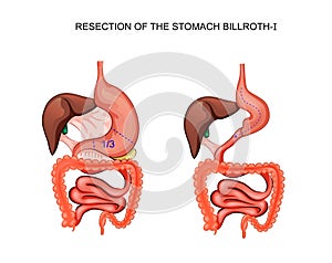 Scheme resection of the stomach Billroth 1 photo
