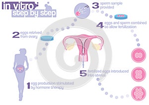 Scheme of in vitro fertilization photo