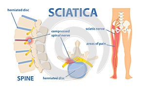 Sciatic nerve pain