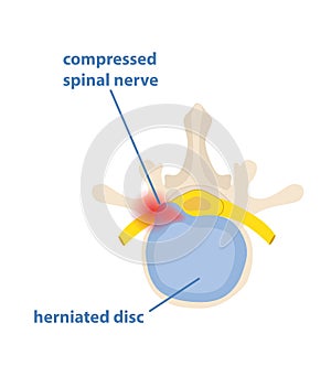 Sciatic nerve pinching concept