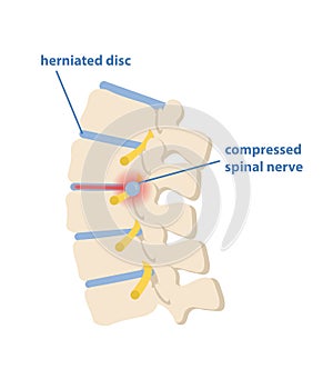 Sciatic nerve pinching concept