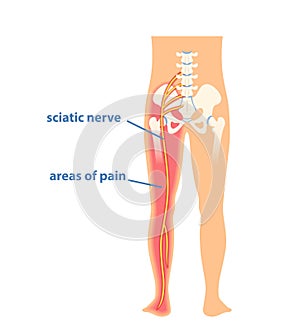 Sciatic nerve pinching concept