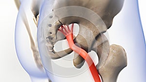 Sciatic Pinched Nerve 3D Render