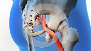 Sciatic Pinched Nerve 3D Render