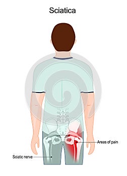 Sciatica. Areas of pain. Sciatic nerve