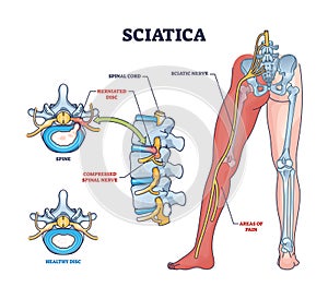 Sciatica as symptom from herniated disc and spinal nerve outline diagram