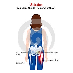 Sciatica.  Body of a patient woman with areas of pain from the back. Piriformis