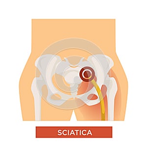 Sciatica bone disease sciatic back pain hip bone
