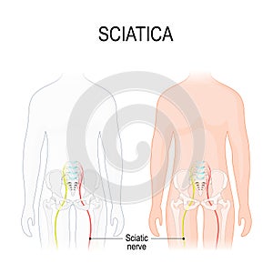 Sciatica. Human body with Sciatic nerve