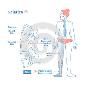 Sciatica medical health care vector illustration diagram scheme with lower spine and sciatic nerve pain in leg.